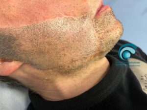 Tricopigmentazione Barba Prima del trattamento | TRICODERMSOLUTIONS